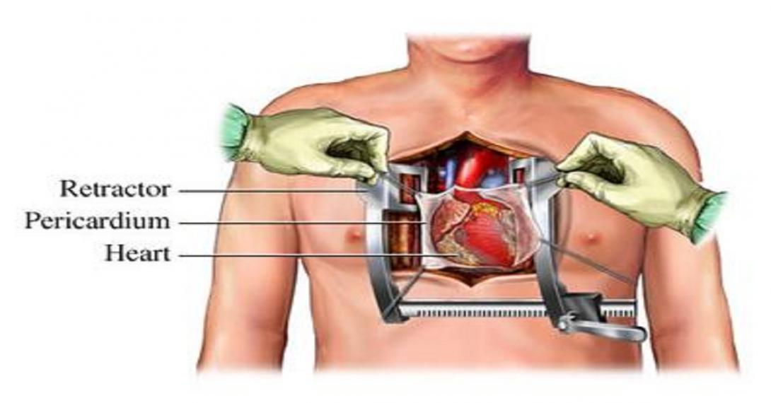 How to get recovery after Open heart surgery?