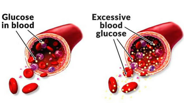 All About Blood Glucose Levels