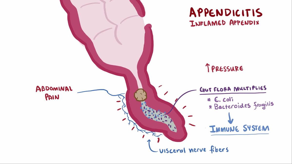 Appendicitis Symptoms,Causes,Diagnosis,Treatment